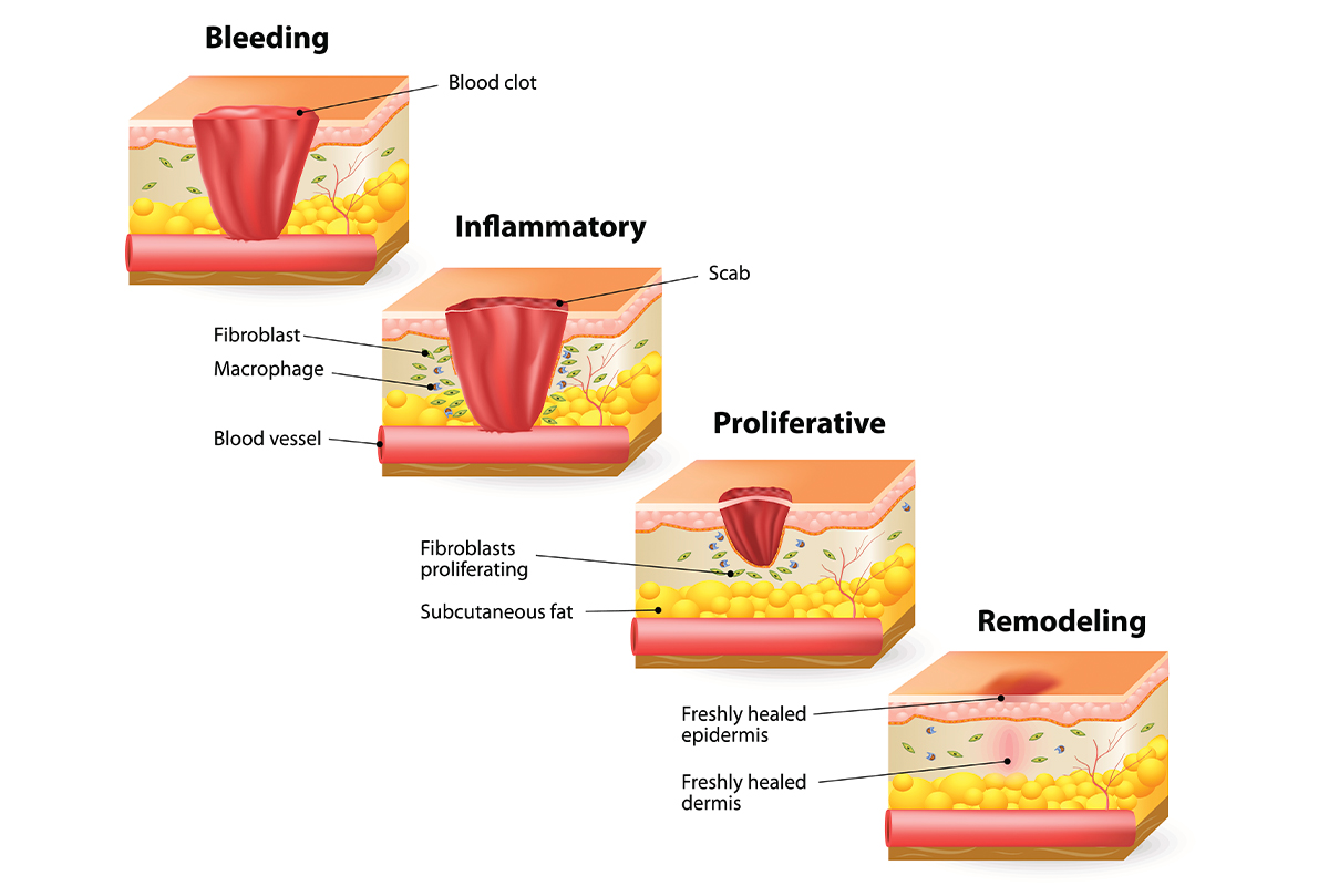 Imagery of burn severity for chronic wounds in Los Angeles.